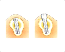 図：「二次手術」