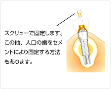 図：「人工の歯を作製・装着」　スクリューで固定します。この他、人口の歯をセメントにより固定する方法もあります。